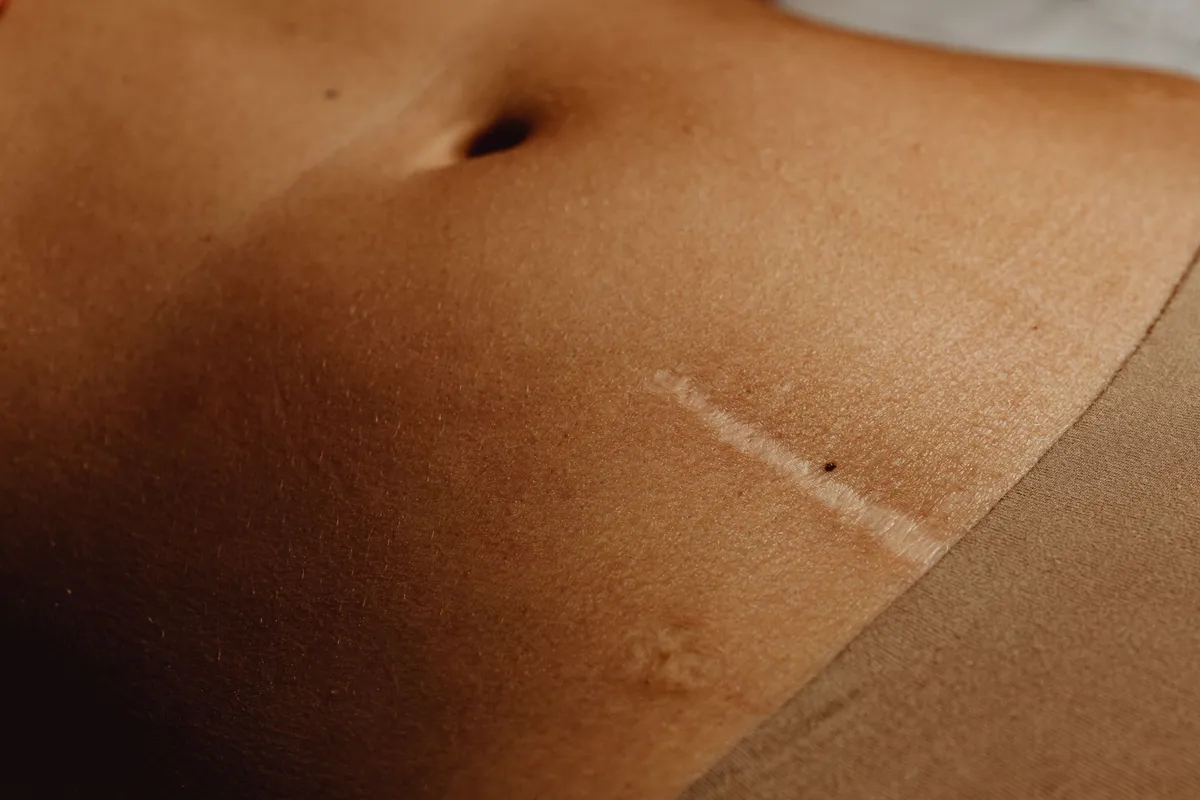 Close-up of a human abdomen with a surgical scar from a tummy tuck procedure.