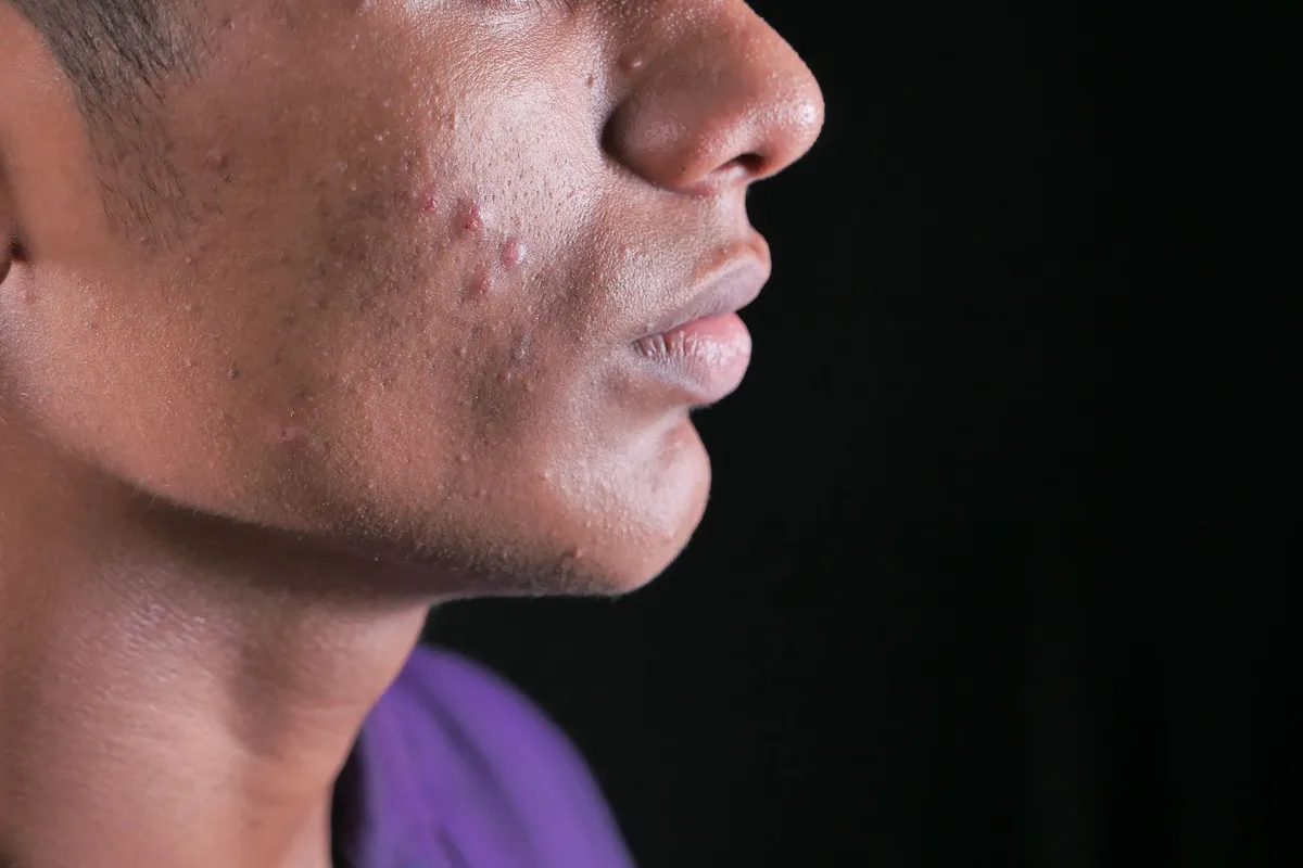 Close-up of a teenager’s face showing acne on the jawline and cheeks.