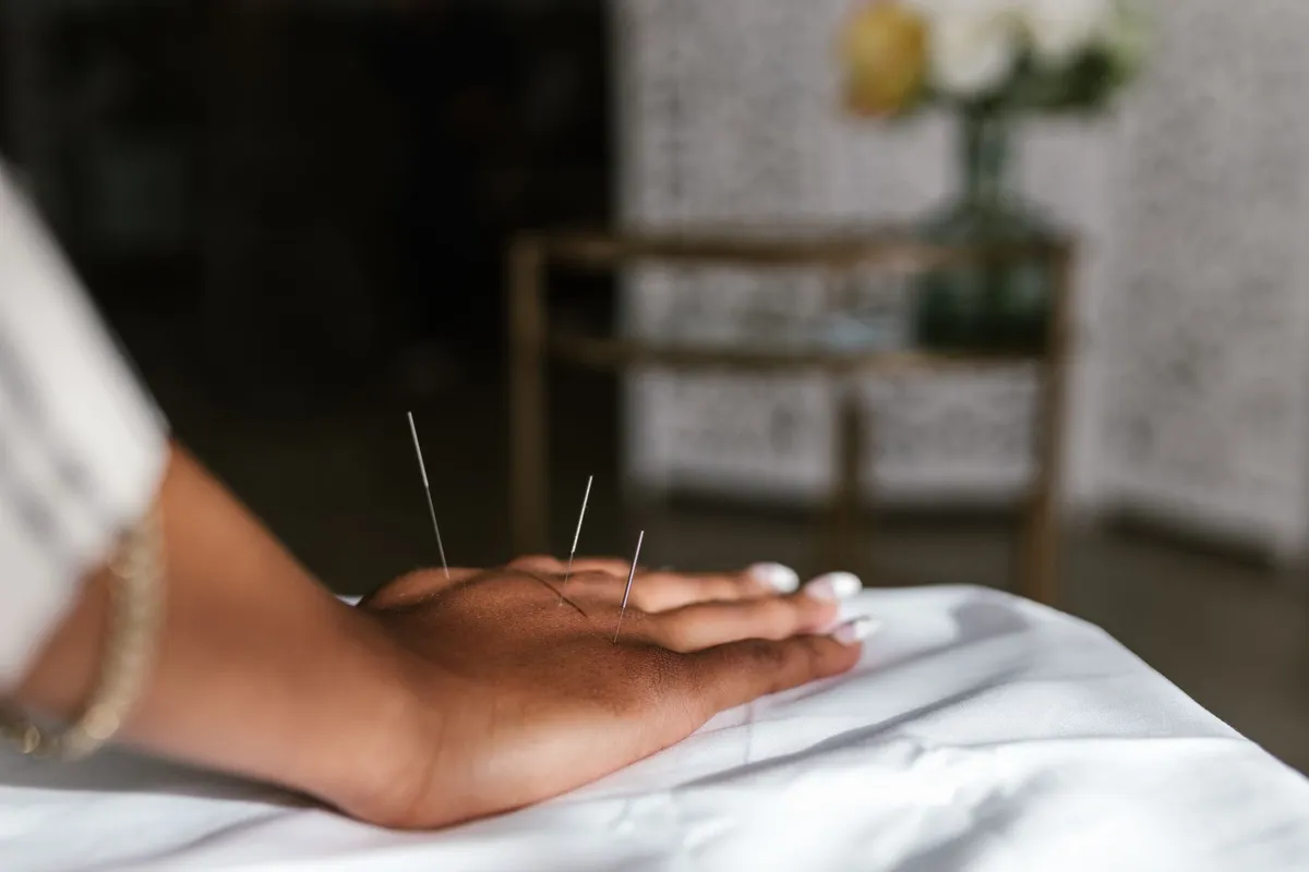 Acupuncture needles inserted in a person’s hand during a treatment session.