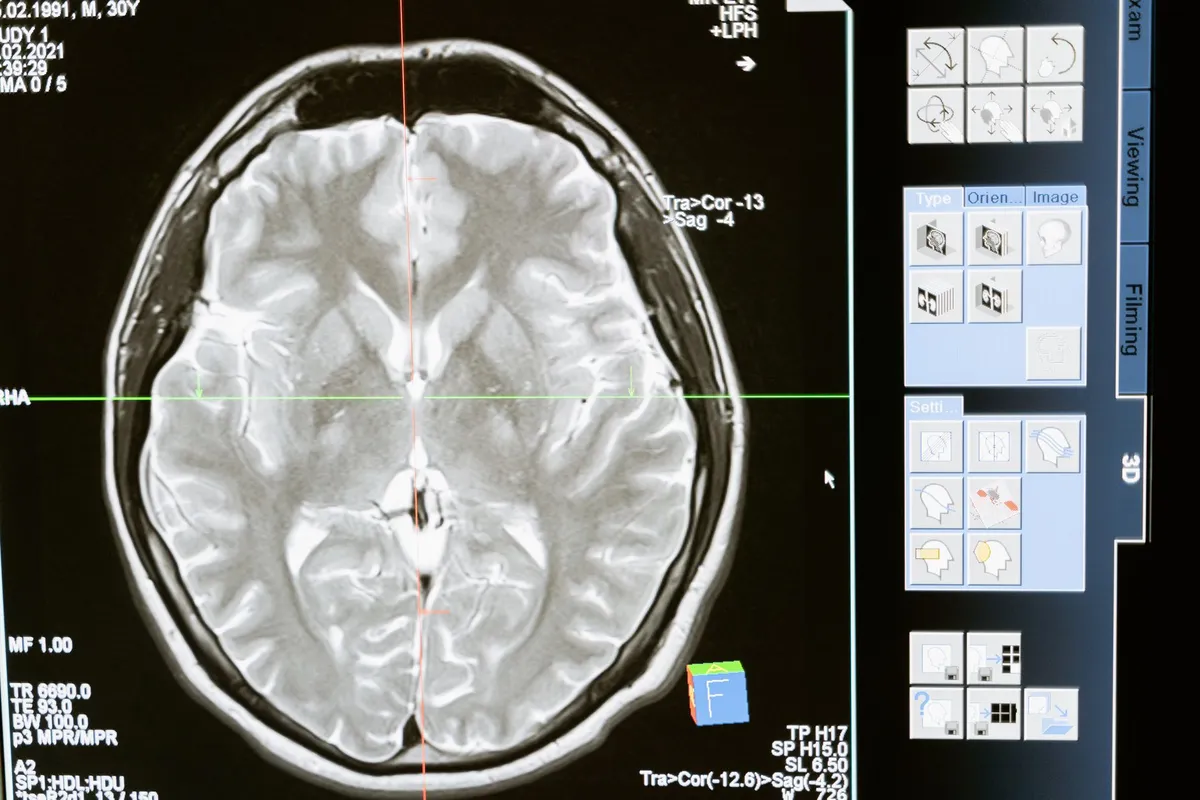 MRI scan of a human brain showing detailed anatomy.