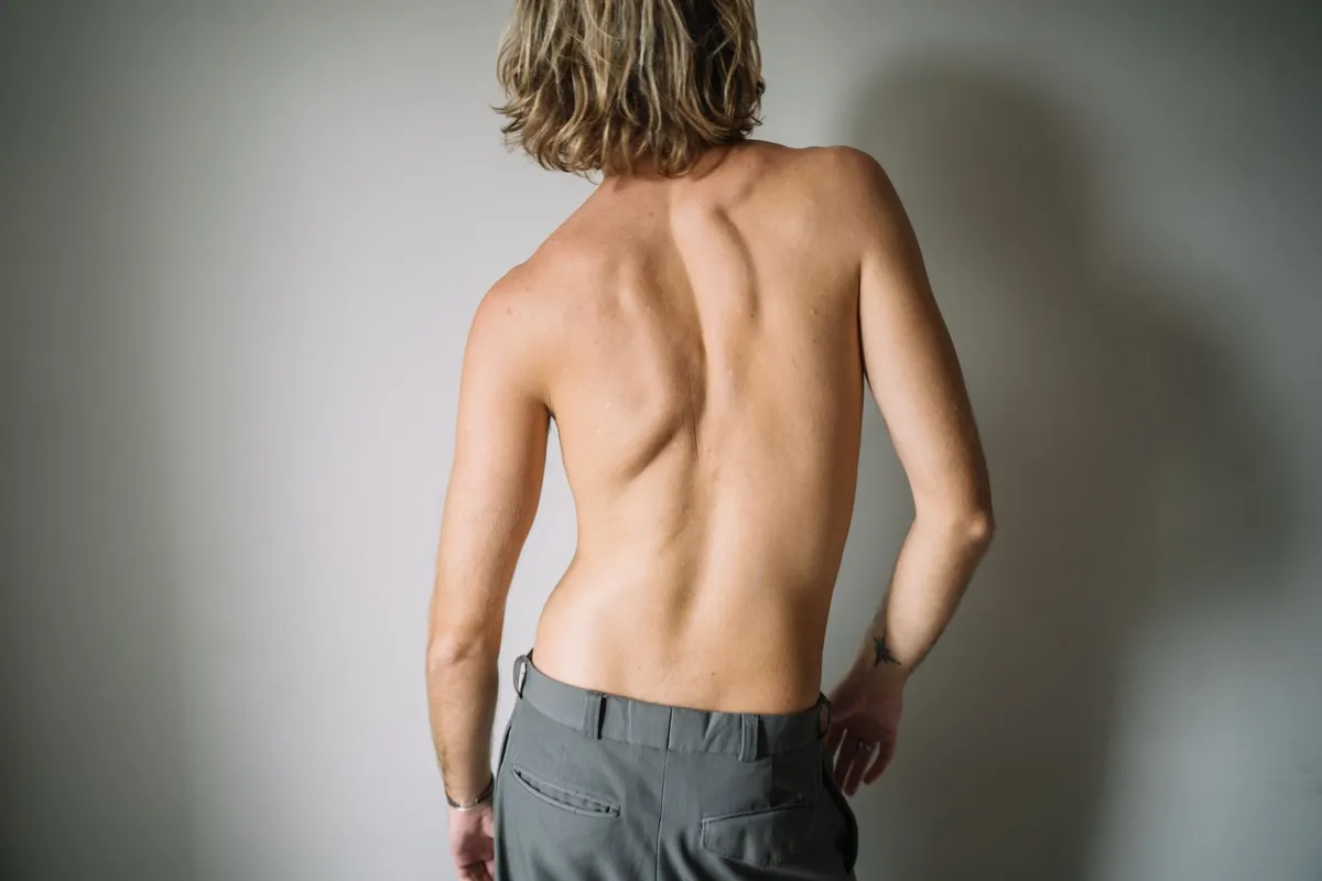 Person showing their back posture, highlighting spinal alignment issues.