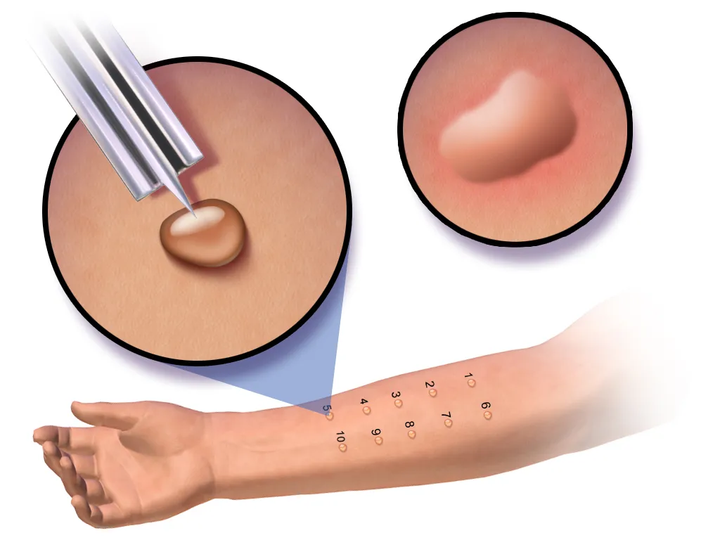 Skin allergy test being performed on a person’s forearm with raised reaction.