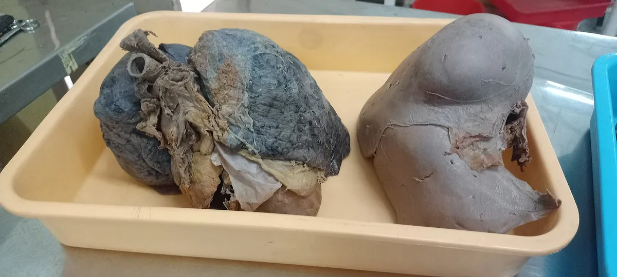 Two damaged human lungs displayed on a tray, showing signs of disease.