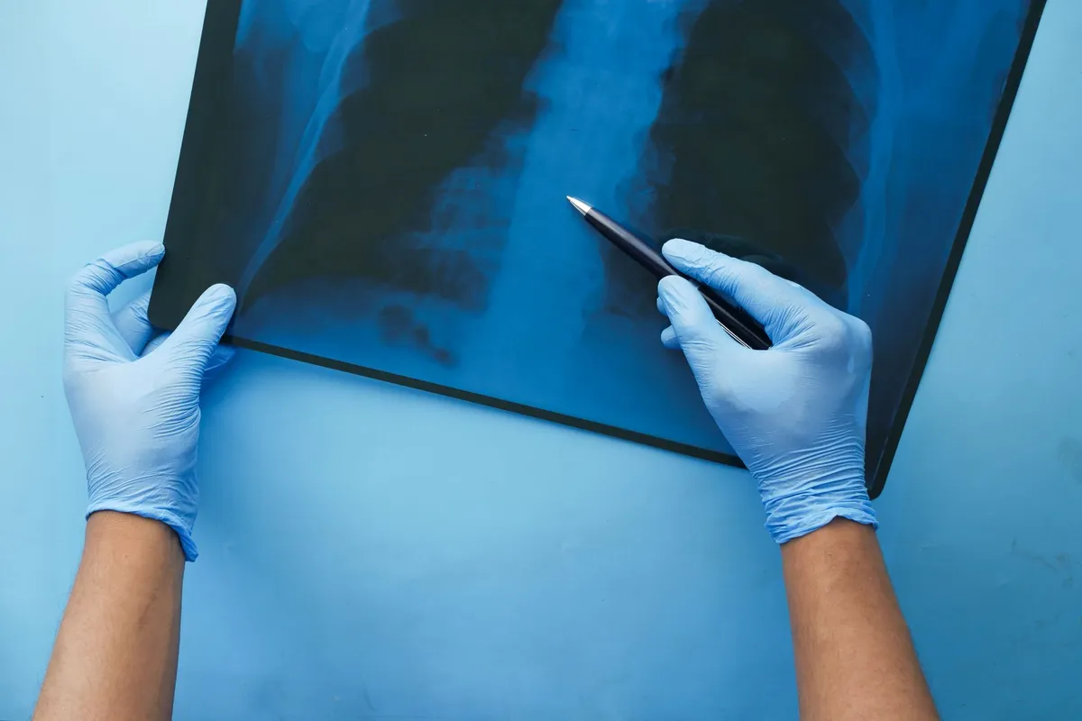 Hands holding an X-ray of lungs with a pen pointing at the image.