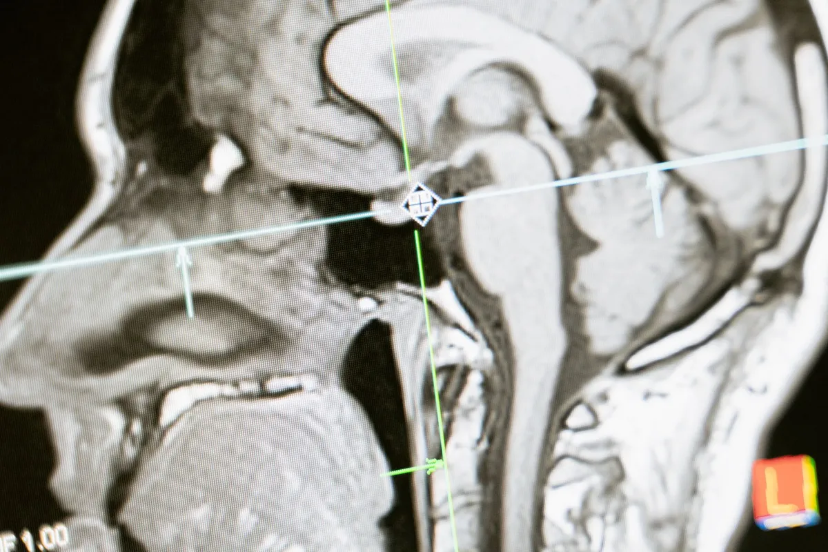 MRI scan of a human brain showing detailed internal structures.