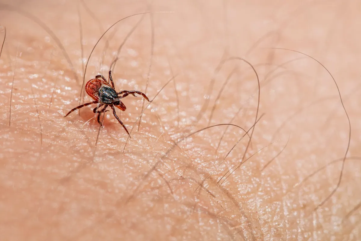 Close-up of a blacklegged tick on human skin, relevant to babesiosis transmission.