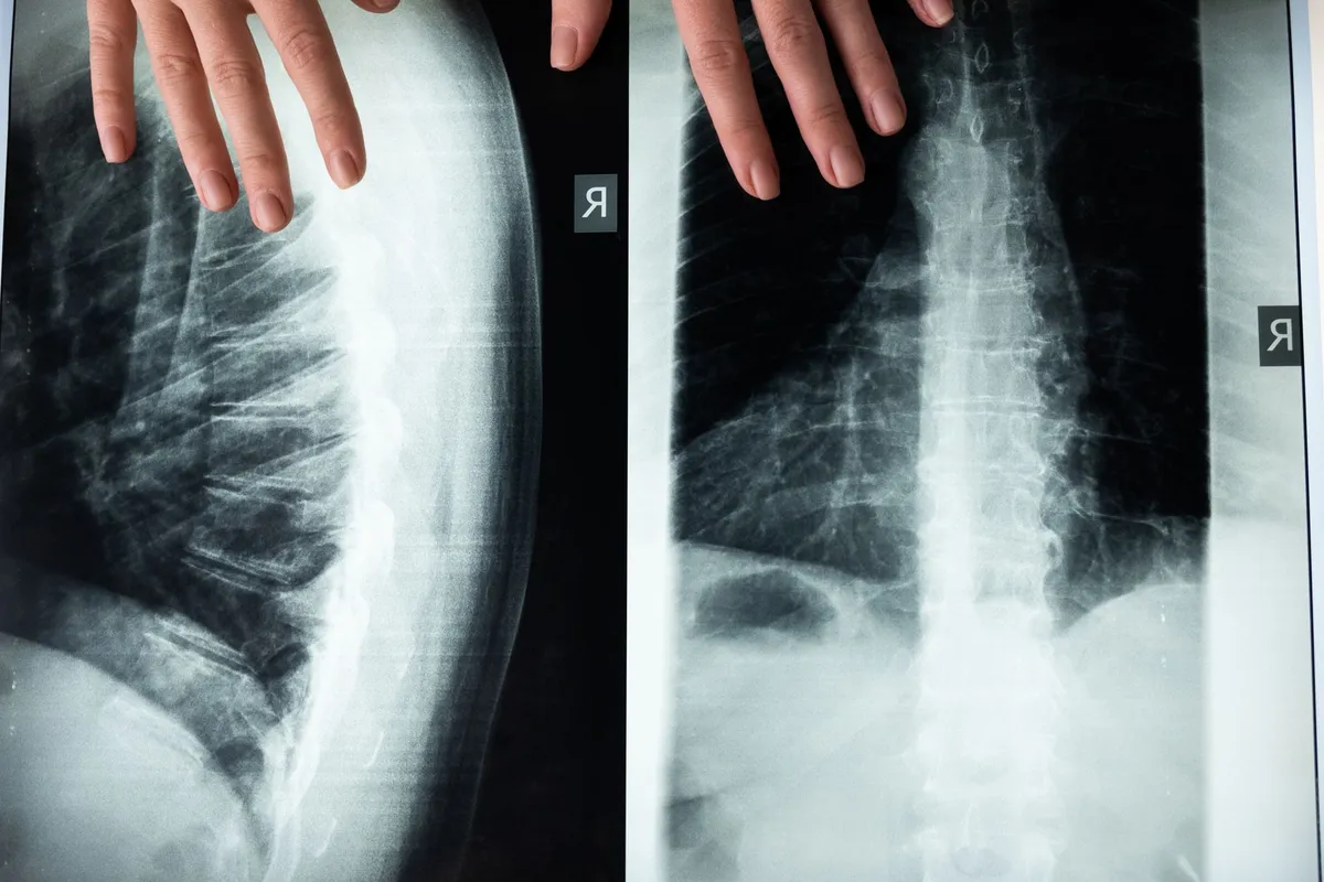 X-ray images showing the spine with intervertebral discs visible.