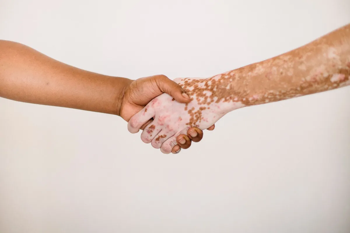 Two hands shaking, one with vitiligo and the other with a normal skin tone.