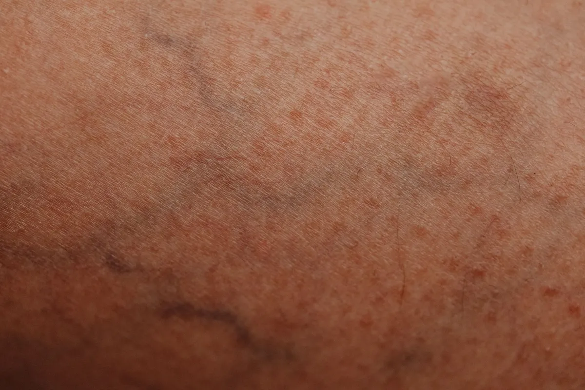 Close-up of skin showing various birthmarks and pigmentation patterns.