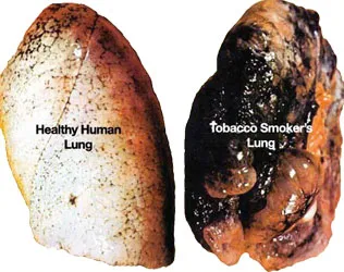 Comparison of healthy human lung and tobacco smoker’s lung