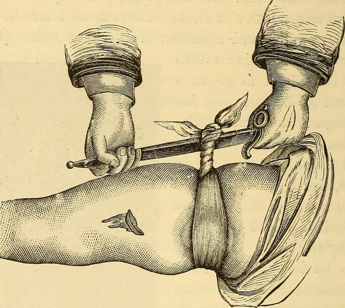 Illustration of a tourniquet applied to a leg wound for bleeding control.