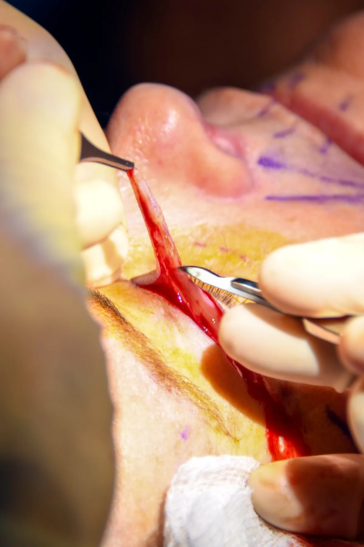 Surgeon performing eyelid surgery on a patient during a blepharoplasty procedure.