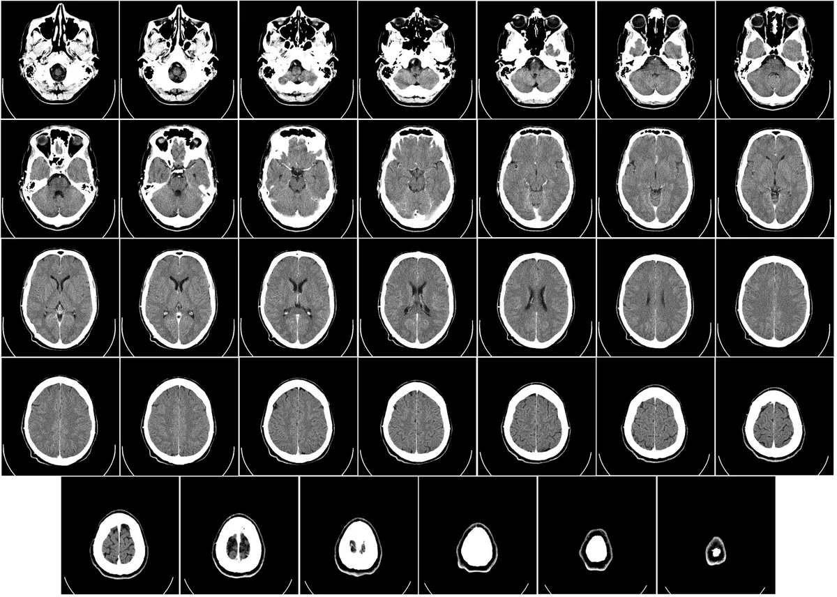 CT scan images of the brain showing various cross-sections and conditions.
