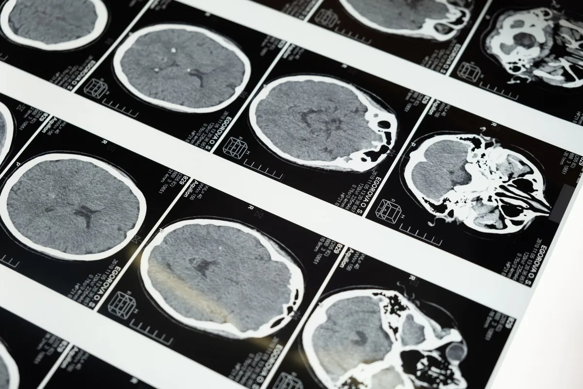 Close-up of brain scans showing various brain conditions, including potential tumors.