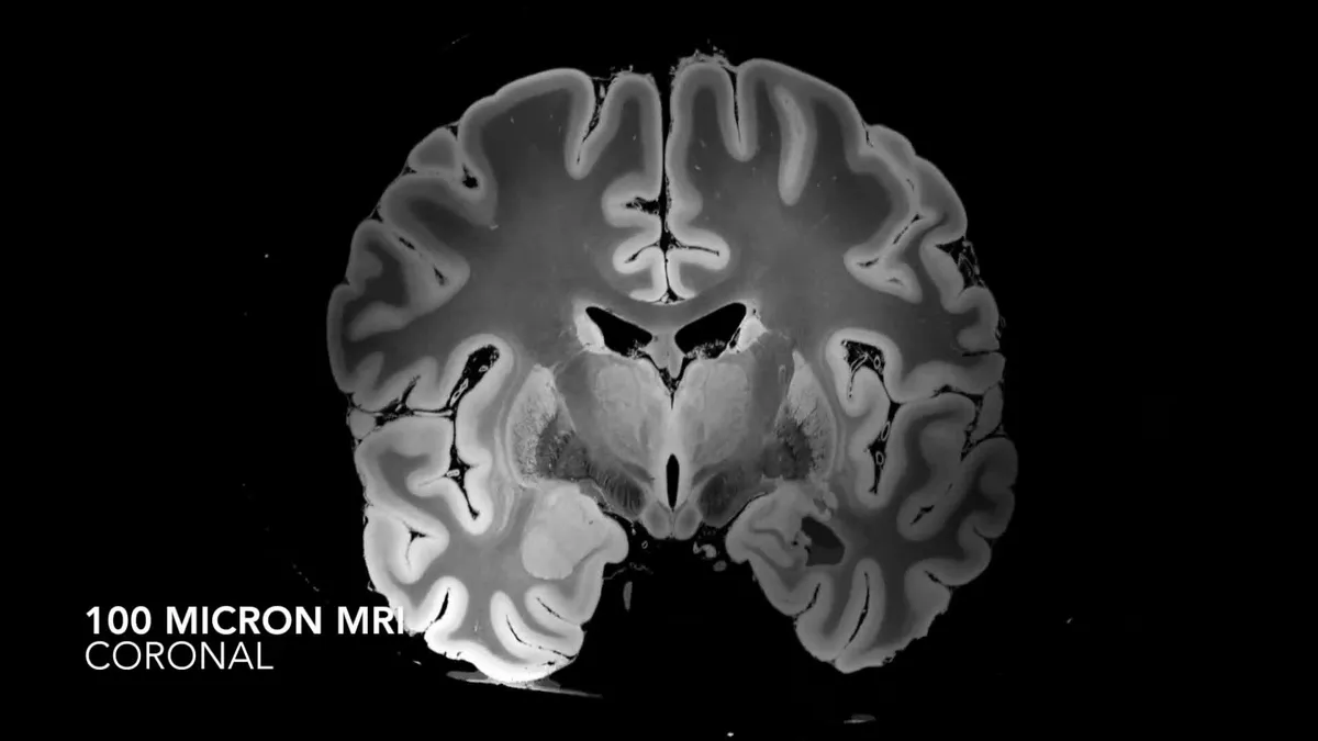 MRI scan of a human brain showing detailed internal structure.