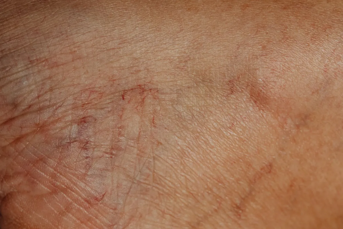 Close-up of skin showing signs of irritation and possible infection on a hand.