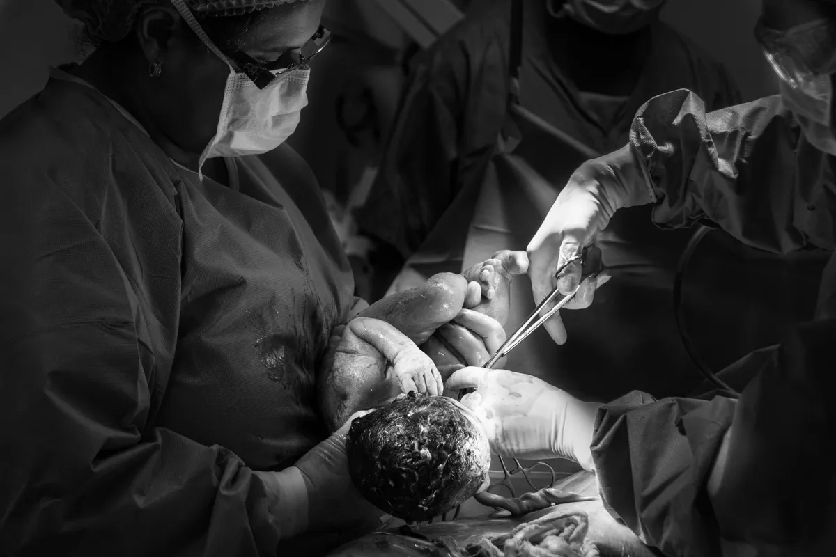 Medical team performing a cesarean section with a newborn visible.