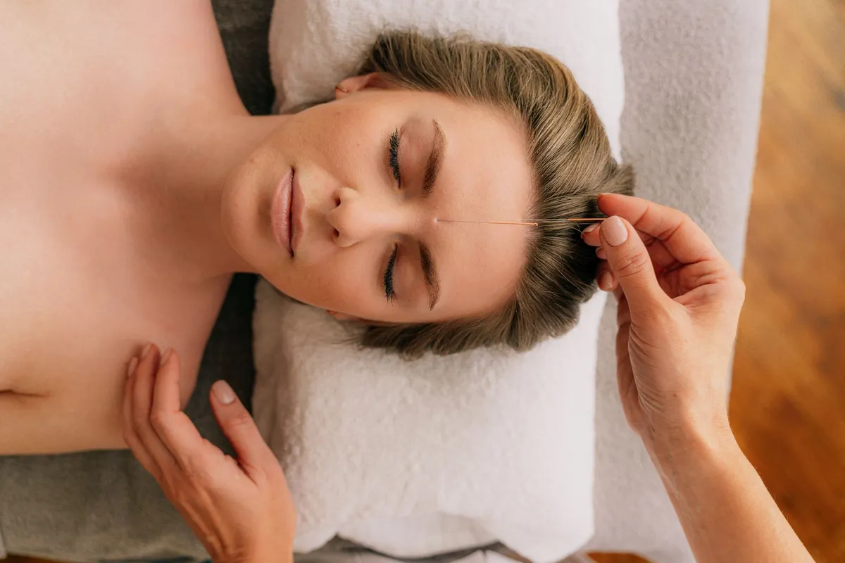 A woman receiving acupuncture treatment with a needle on her forehead.