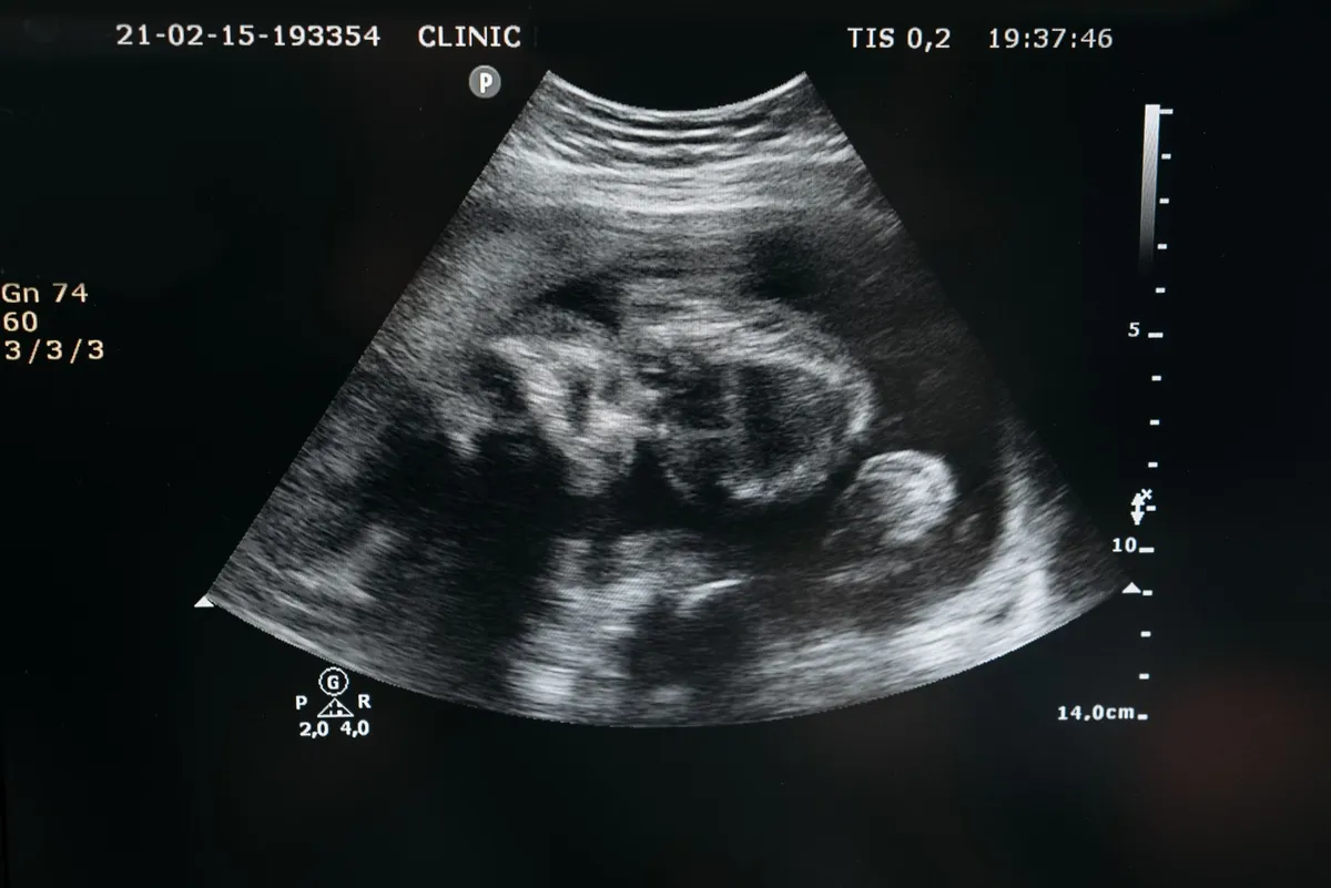 Ultrasound image showing a developing fetus in the womb.