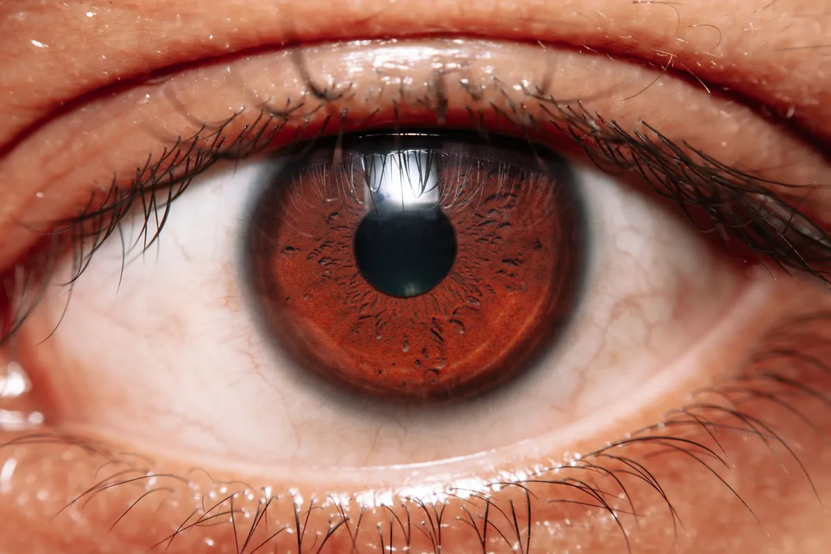 Close-up of a brown eye showing redness, possibly indicating conjunctivitis symptoms.