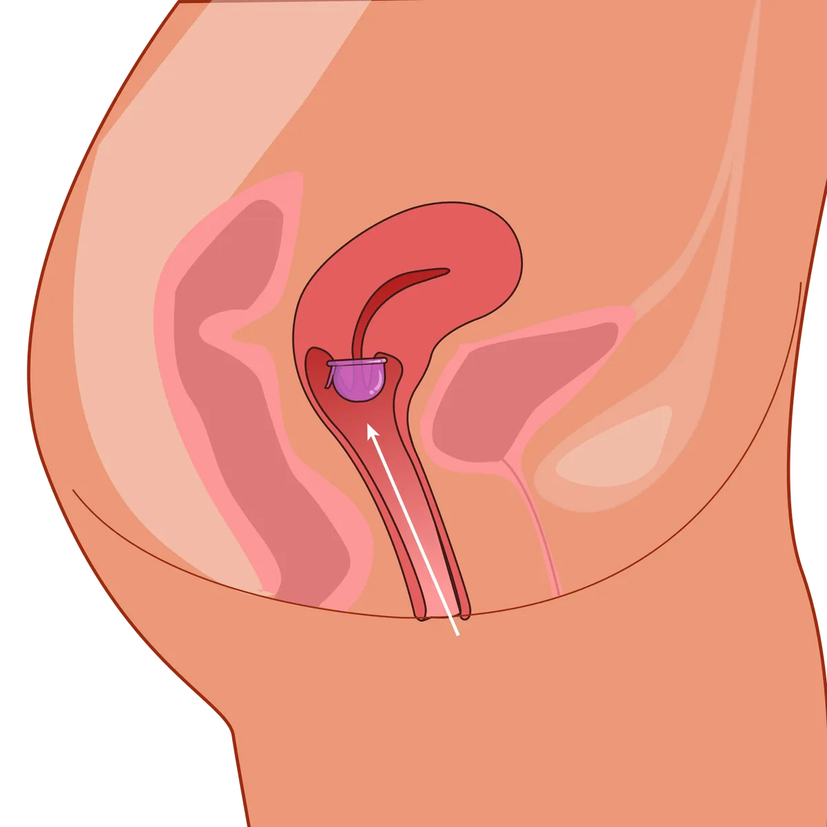 Illustration of the female reproductive system highlighting the uterus and IUD placement.