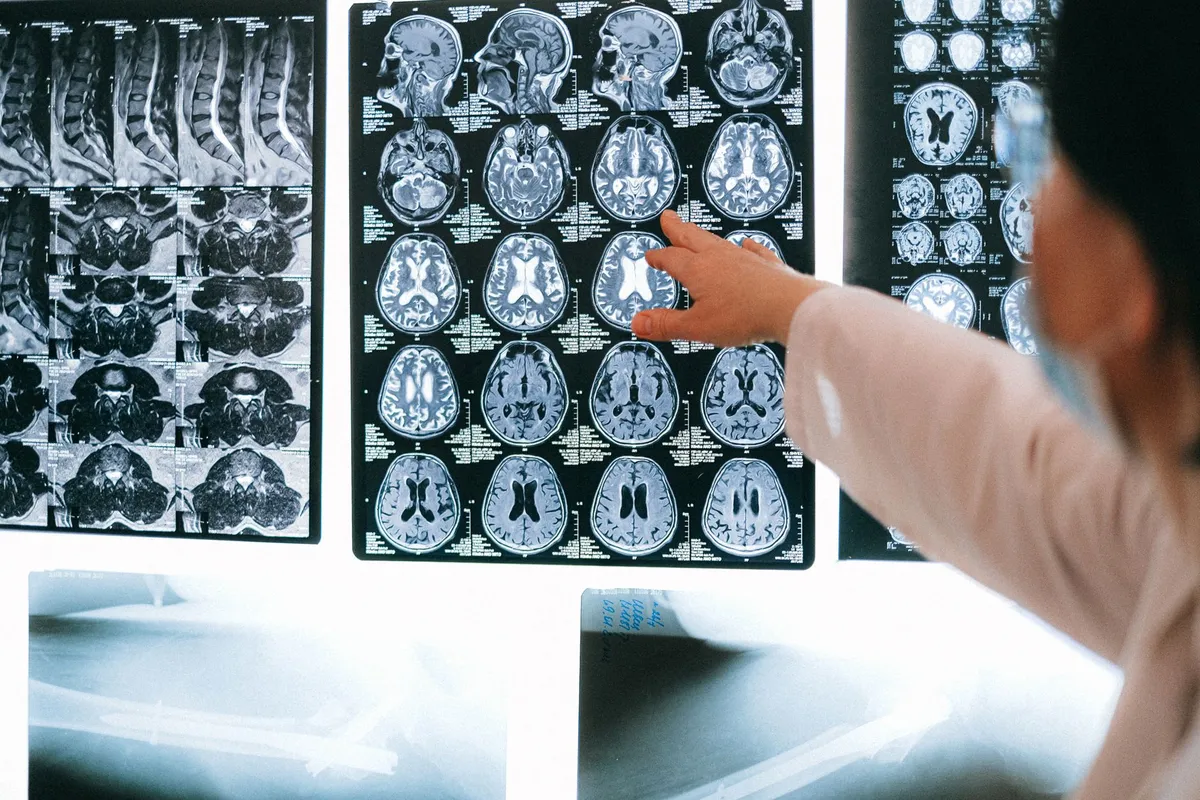 Medical professional pointing at brain MRI scans on a light board.
