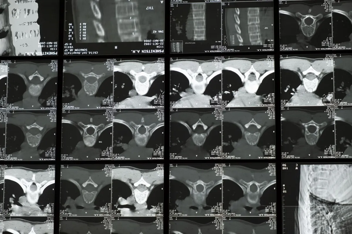 Multiple CT scan images showing cross sections of the spine and surrounding structures.