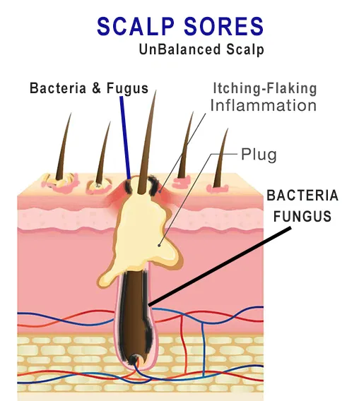 Illustration of scalp sores showing bacteria, fungus, and inflammation