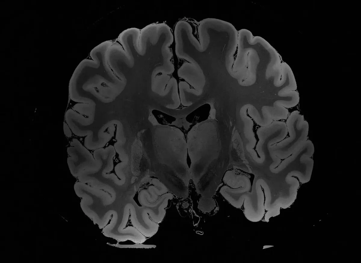 Cross-sectional view of a human brain showing anatomical structures.